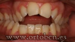 mordida abierta anterior